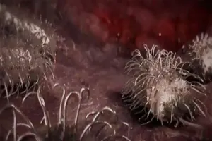 Bị vi khuẩn 'ăn thịt người’ ăn mất nửa gương mặt