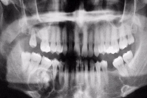 Tình cờ phát hiện u răng khi chụp X-quang