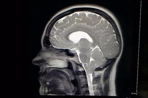 Không dám cười to vì sợ... thủng màng não