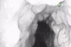 Kinh hoàng hàng loạt răng mọc trong cổ họng