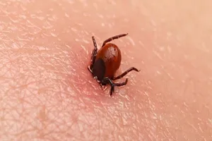 Liệt, mất trí nhớ vì bị ve cắn 16 năm trước