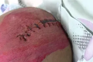 Em bé gần 3 tháng tuổi chấn thương sọ não vì điện thoại rơi