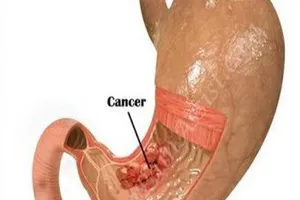 Có những dấu hiệu này cần nghĩ ngay đến ung thư dạ dày