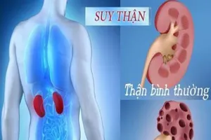 Những điều cần biết về bệnh suy thận mạn tính