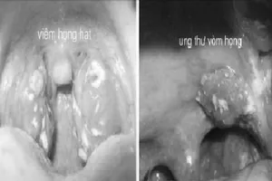 Cách phân biệt ung thư vòm họng và viêm họng