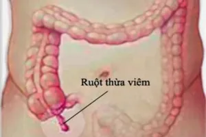 Hút 4 lít dịch mủ trong bụng sản phụ viêm ruột thừa vỡ hoại tử