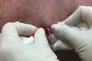 Coi chừng mất mạng vì thói quen nặn mụn 