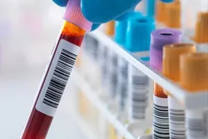 Viêm gan có thể dẫn đến ung thư gan không?