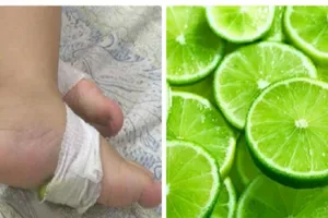 Sốt co giật, vắt chanh vào miệng, bé lập tức tím tái 