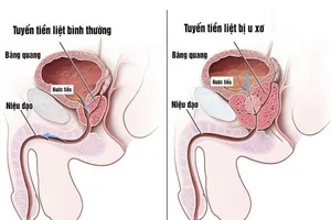 Tuyến tiền liệt bình thường và tuyến tiền liệt bị u xơ. Ảnh: Internet