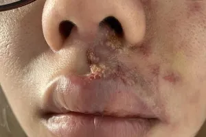 Mặt sưng phù, mưng mủ sau tiêm filler làm đầy rãnh má