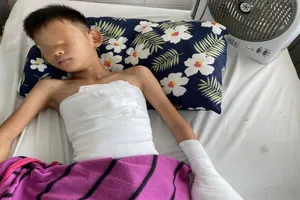 Gần nát bàn tay do tai nạn pháo