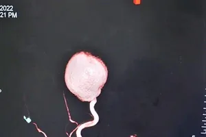 Cứu sống bệnh nhân phình động mạch “khổng lồ”