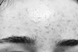 Nhập viện sau đắp mặt, bôi kem trị trứng cá ở spa gần nhà