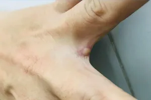 Bệnh nhân đậu mùa khỉ đầu tiên hồi phục tốt sau 12 ngày điều trị