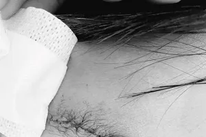 Nghịch súng hơi, bé trai bị đạn chì găm vào xương sọ