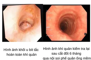 Bị khối u hiếm bít khí quản, cô gái suy hô hấp nguy kịch
