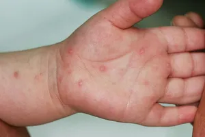 Đã xác định subgenotype của Enterovirus 71 gây bệnh tay chân miệng nặng ở trẻ em