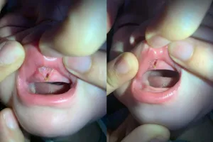 Khi nào cắt thắng môi, thắng lưỡi cho trẻ?