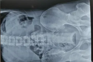 Nam thanh niên bị kẹt đồ chơi tình dục trong trực tràng