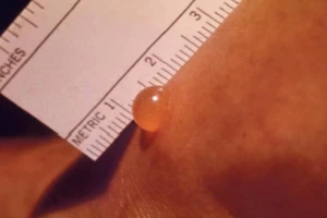 Bé gái 3 tuổi nguy kịch vì bệnh sốt mò