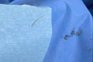 Hóc xương cá, người phụ nữ bị nhiễm trùng huyết suýt tử vong