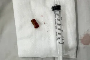 Ho kéo dài vì chiếc kèn bị bỏ quên trong phổi 7 năm