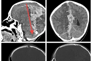 Bé gái 6 tuổi bị thân vợt cầu lông xuyên vào đầu