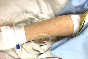 Người phụ nữ bị phản vệ độ 3 sau tiêm vaccine 