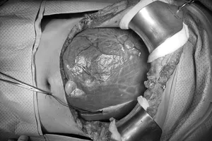 Cô gái trẻ mắc khối u gan khổng lồ hiếm gặp nặng 3 ký