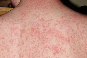 Khi nào trẻ tiêm mũi vaccine sởi đầu tiên?