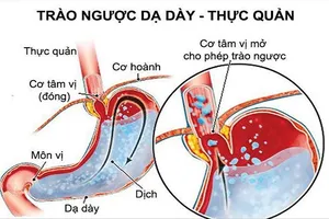 Cách nhận biết sớm bệnh trào ngược dạ dày thực quản
