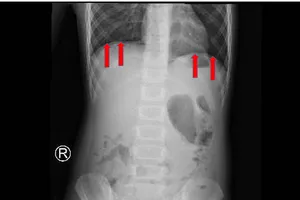 Đang học bé gái than đau bụng, không ngờ thủng dạ dày hiếm gặp