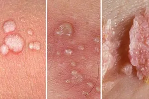 Bị sùi mào gà có vô sinh không?