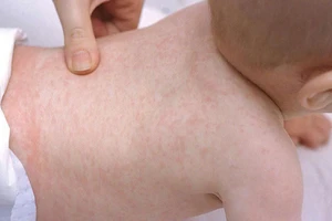 Chuyên gia chỉ cách chăm sóc trẻ sốt siêu vi tại nhà 