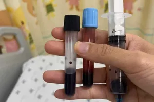 Máu bé gái chuyển đen do ngộ độc methemoglobin sau bữa ăn