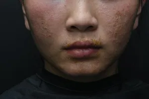 Nhiều ca biến chứng, phải nhập viện vì muốn đẹp nhanh