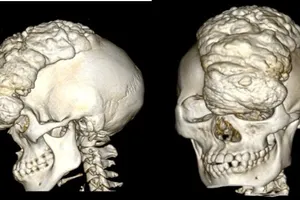 Khối u khổng lồ làm biến dạng khuôn mặt cô gái suốt 15 năm