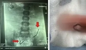 Bé trai 5 tuổi thủng ruột 8 lỗ vì nuốt 20 viên nam châm