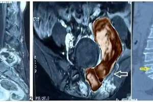 Khối u ác tính vùng cột sống thắt lưng