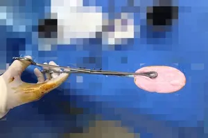 Bé gái 12 tuổi cấp cứu vì nhét cục xà phòng vào vùng kín