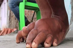 Việt Nam được công nhận loại trừ bệnh phù chân voi 