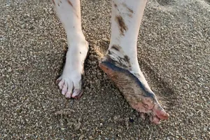 Dầu vón cục tràn vào bãi biển Tuy Hòa