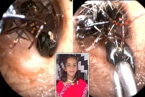 Ấn Độ: Tổ kiến khổng lồ trong tai một cô bé 12 tuổi