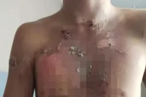 Năm nam sinh được cho là bị bóp cổ liên tục cho đến khi họ bất tỉnh sau đó lại bị dội nước sôi vào người.