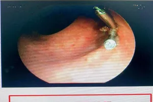 Trực tràng có nhú mạch máu to sau khi được các BS dùng kẹp clip cầm máu. Ảnh: BVCC.