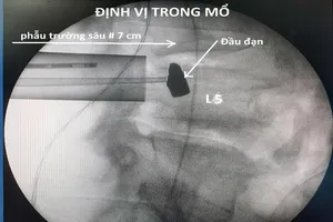 Lấy thành công đầu đạn 51 năm nằm trong cơ thể