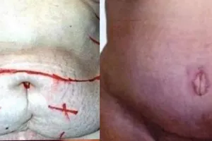 Gần 4 tiếng hút mỡ ra khỏi người phụ nữ bị 'béo phì'