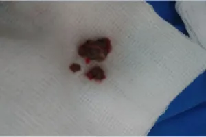 Mẩu xương heo nằm trong phổi nam bệnh nhân suốt một năm