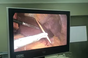 Người đàn ông bị tăm đâm thủng dạ dày, xuyên gan